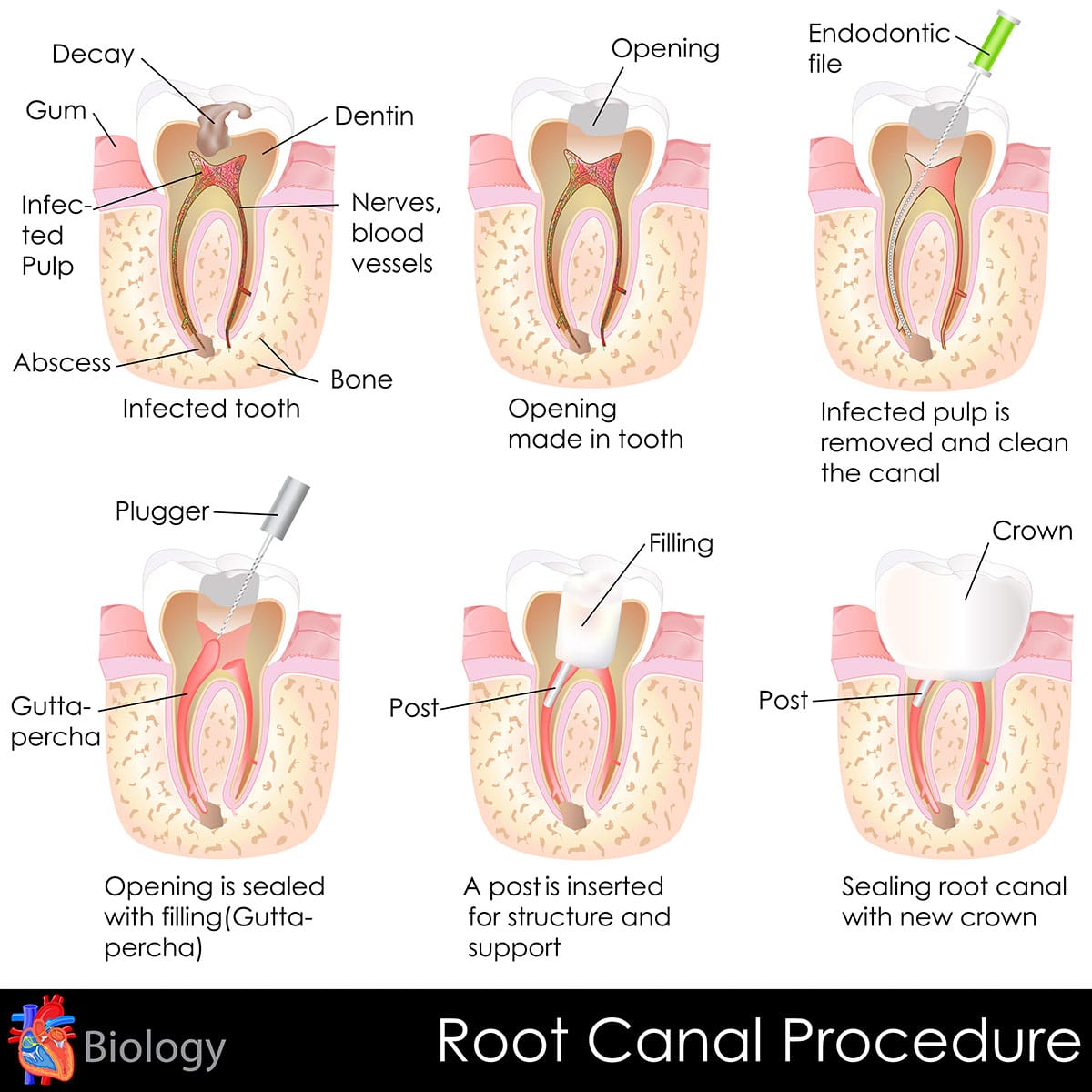 Root Canal Treatment Waco AWD Family Dentist Waco Temple