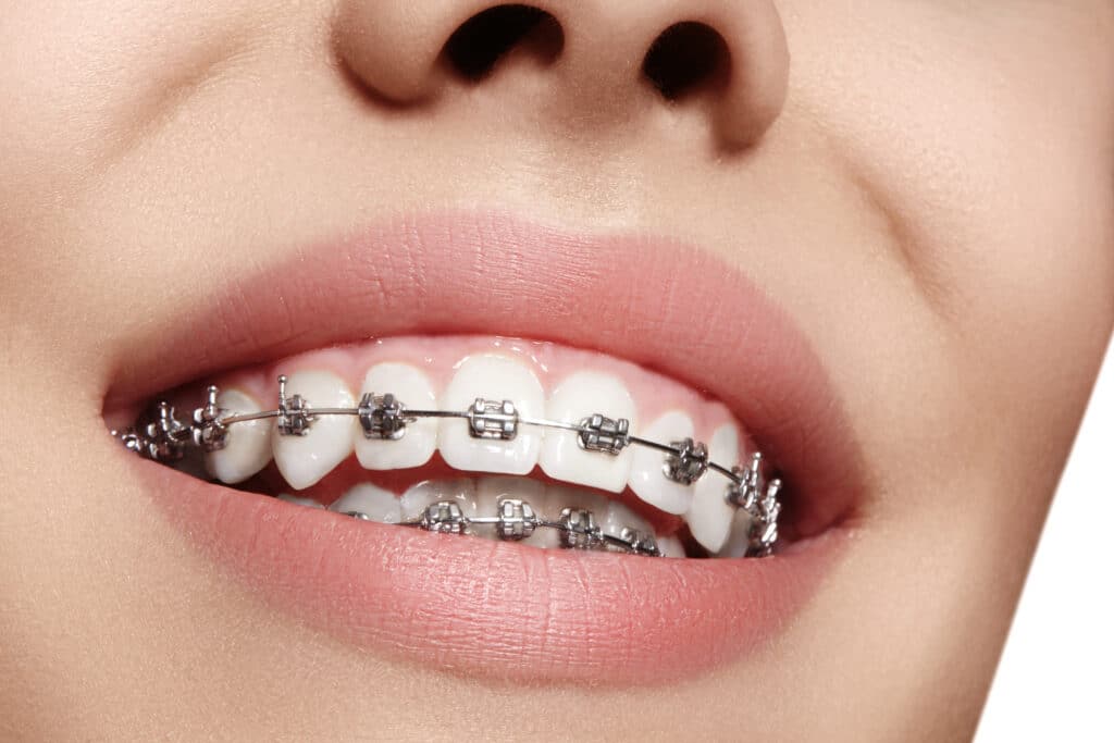 Braces Waco Dentist in Temple. Acre Wood Dental. We provide the finest in family, cosmetic, implant dentistry in Waco, Temple & Gatesville 254-256-2616. Enhancing Your Smile With the Best Dentist in Temple, Texas! Acrewood Dental in Waco temple and gatesville